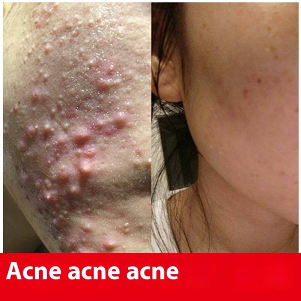 Herbal anti-acne solution, fade acne marks and pits, closed mouth anti-acne water, shrink pores, gentle anti-acne essence wholesale - Image 3