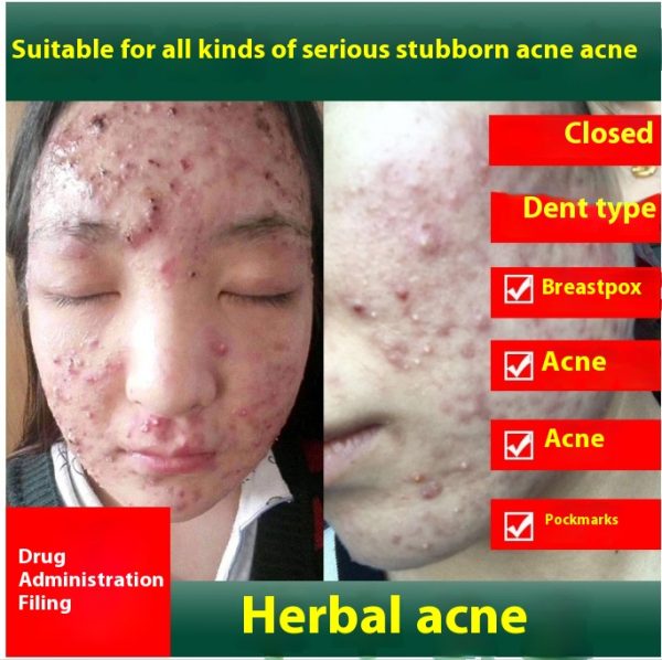 Acne Treatment Cream acne removing acne male and female students smallpox diluting acne scar cream anti-printing repair pox pits wholesale