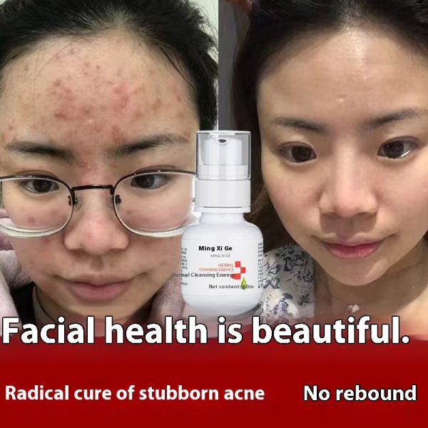 Herbal anti-acne solution, fade acne marks and pits, closed mouth anti-acne water, shrink pores, gentle anti-acne essence wholesale