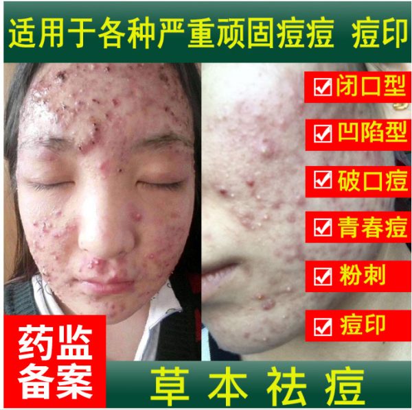 Acne Treatment Cream acne removing acne male and female students smallpox diluting acne scar cream anti-printing repair pox pits wholesale - Image 6