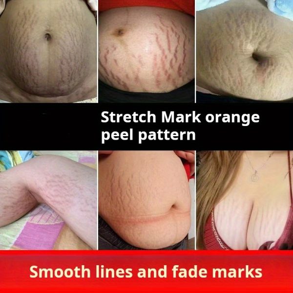 Stretch Mark Cream Obesity Body Mark Repair Cream Firming Nourishing Lightening Postpartum Pregnancy Mark Repair Cream wholesale - Image 2