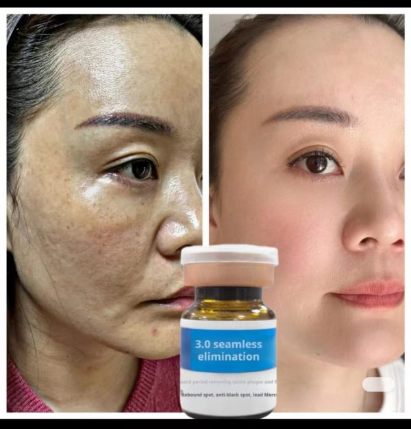 Non-invasive spot dissolving solution, non-peeling, non-scabbing, no embarrassing period, freckle removal solution to remove chloasma, age spots, freckles, melanin decomposition and lightening essence